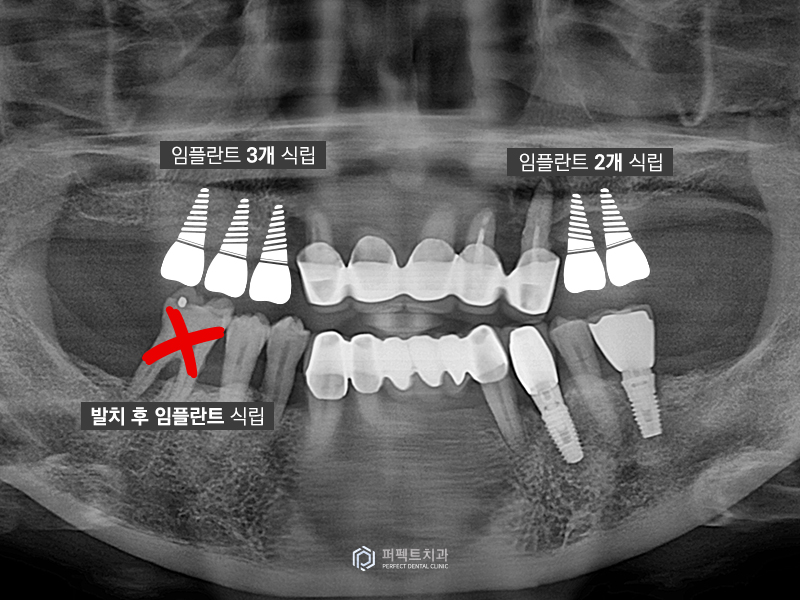 네비게이션 가이드로 전악임플란트를 20분만에? 관련 이미지 3