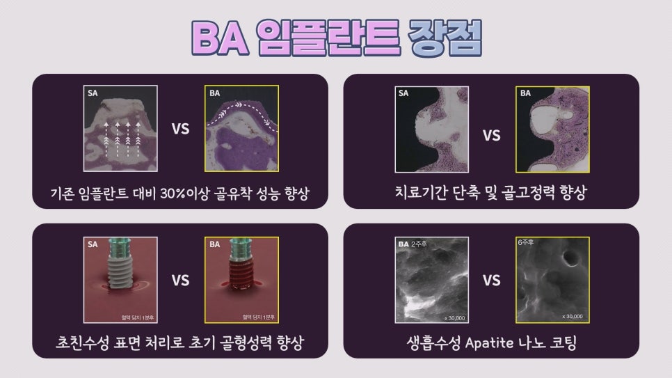 임플란트 종류③|BA, SOI 임플란트의 장점은? 관련 이미지 2
