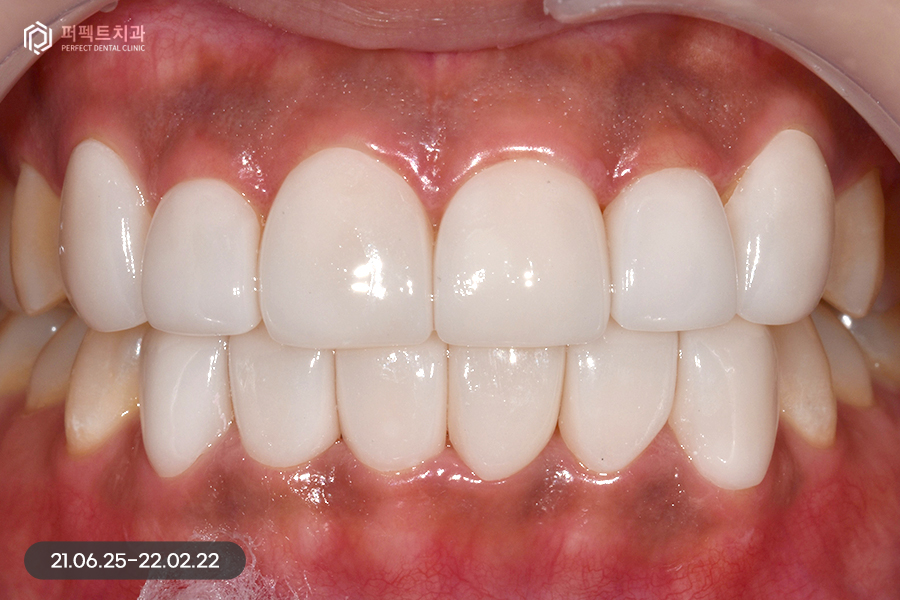 삐뚠 치아도 최소삭제가 가능하게👌🏻 교정 후 폴리네이트 관련 이미지 8