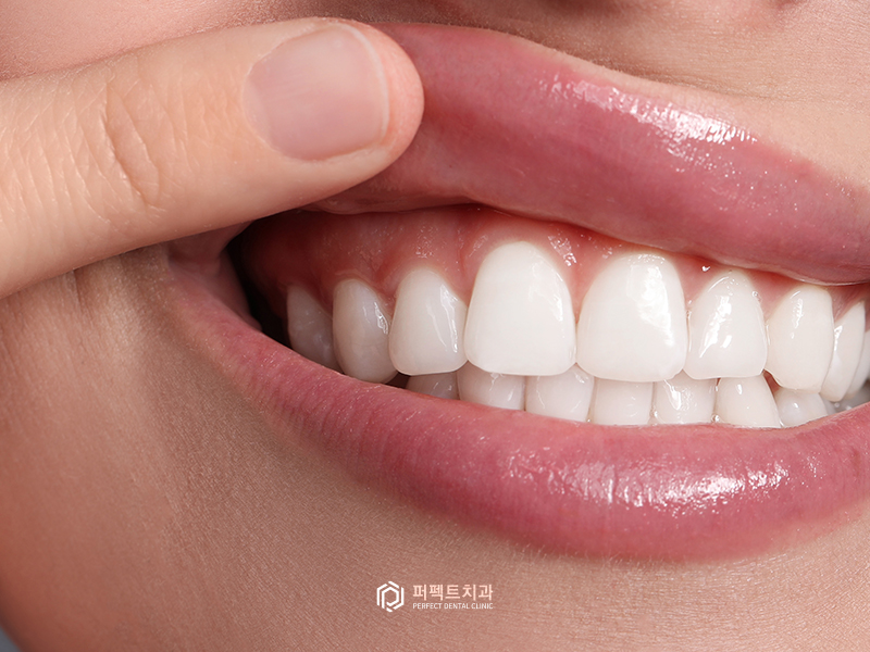 #1탄_의료보험 적용되는 치과치료는?(스케일링편) 관련 이미지 4