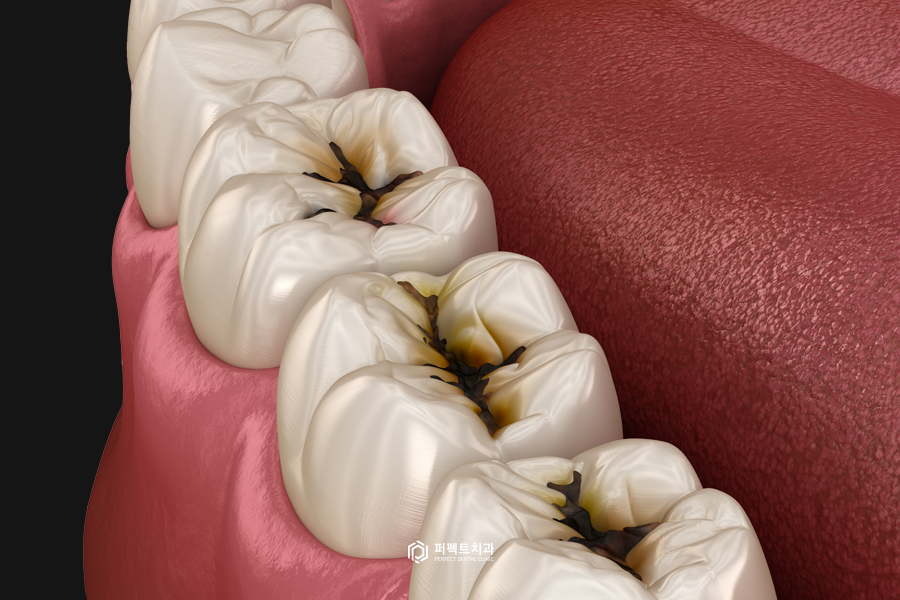 치아가 시린 다양한 이유! 관련 이미지 3