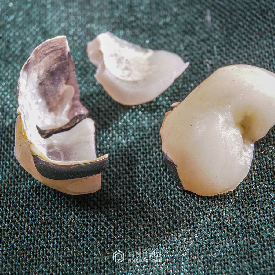 임시치아 시리즈 #3, 임시치아 후 빠짐or깨짐 어떻게?! 관련 이미지 2