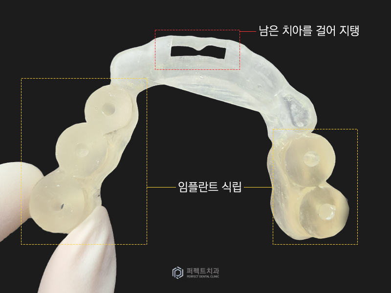 네비게이션 가이드로 전악임플란트를 20분만에? 관련 이미지 7
