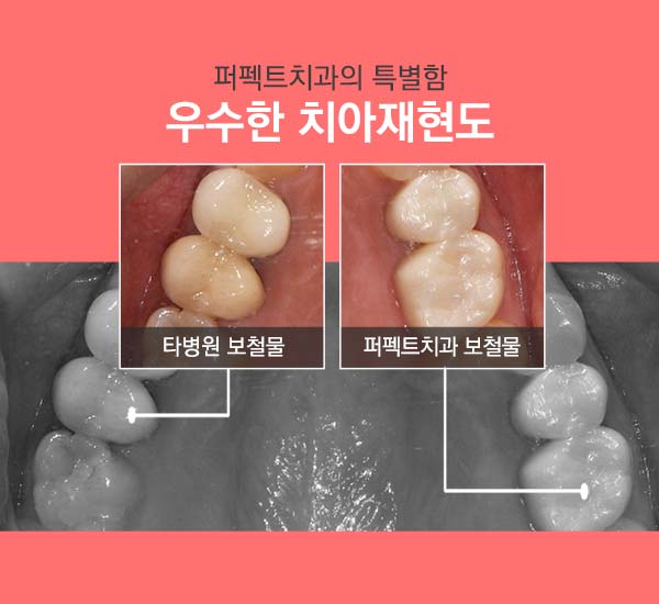 선릉역 지르코니아가격 관련 이미지 2