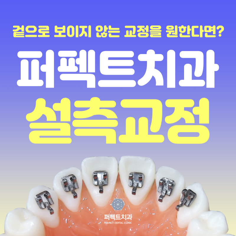 치아안쪽에 부착하는 설측교정! 관련 이미지 1