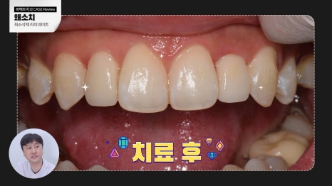 주변 치아보다 작은 관련 이미지 7
