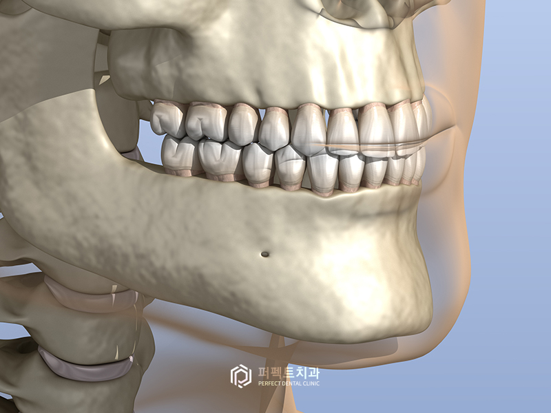 돌출입 교정 시 입을 얼마나 넣을 수 있을까? 관련 이미지 4