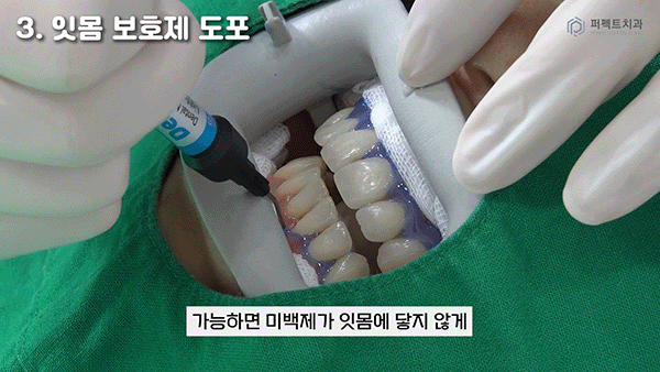 직접 받아본✨치아미백 과정① 관련 이미지 4