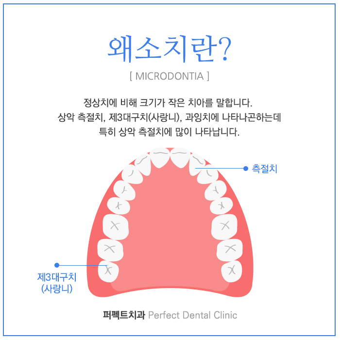 교정 후 왜소치라미네이트 시술! 관련 이미지 1