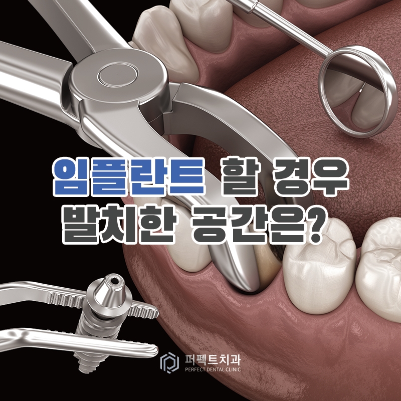 임플란트를 할 경우 발치한 공간은 비어있어야 하나요? 관련 이미지 1
