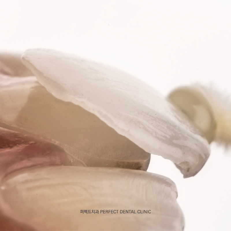 라미네이트도 변색, 착색이 되나요? 관련 이미지 2