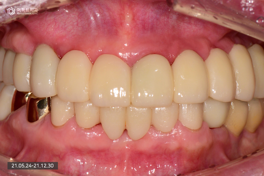 치아가 하나도 없을 때 필요한 전악임플란트😬 관련 이미지 9