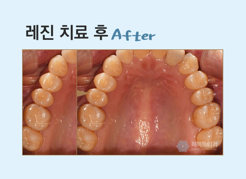 레진필링으로 벌어진 치아 메꾸자 관련 이미지 8