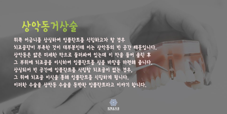 고난도 상악동거상술에 대해 알아보자! 관련 이미지 3