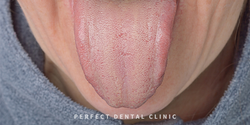 설태 생기는 이유와 없애는 방법 관련 이미지 2