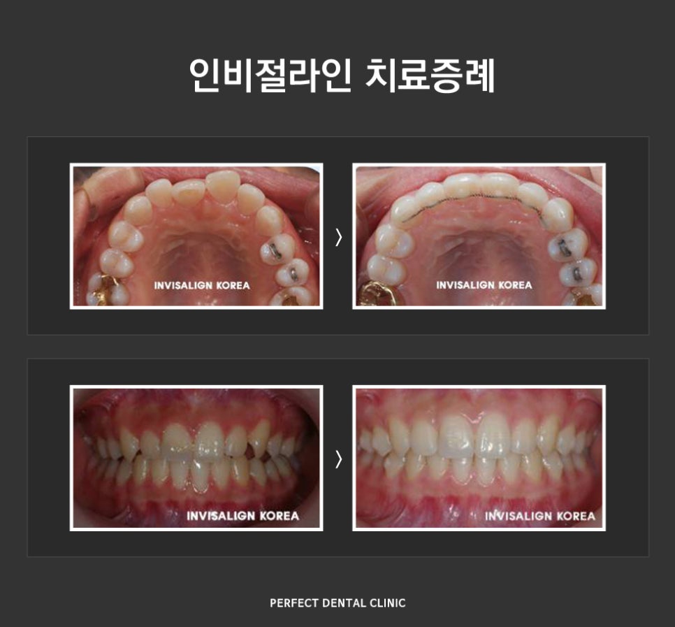 보이지 않는 투명교정 인비절라인 관련 이미지 4