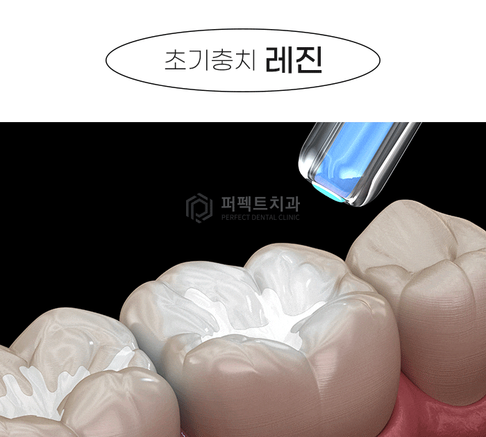 미룰수록 어려운 충치치료, 초기에 치료해요! 관련 이미지 5