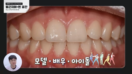 연예인 라미네이트, 최소삭제 라미네이트로! 관련 이미지 2