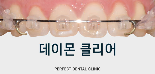 퍼펙트치과 전체교정 비용 궁금해? 관련 이미지 4