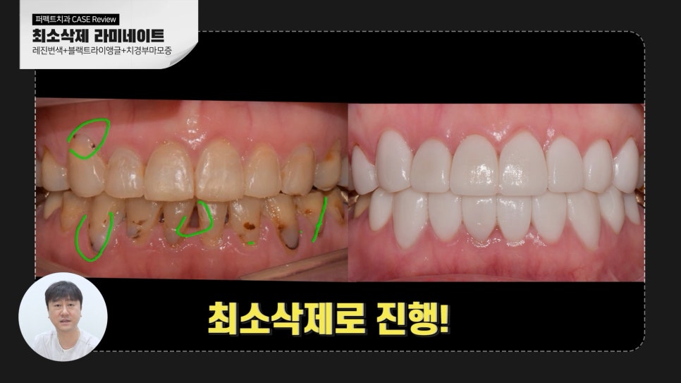 변색된 레진👉라미네이트 교체 관련 이미지 5