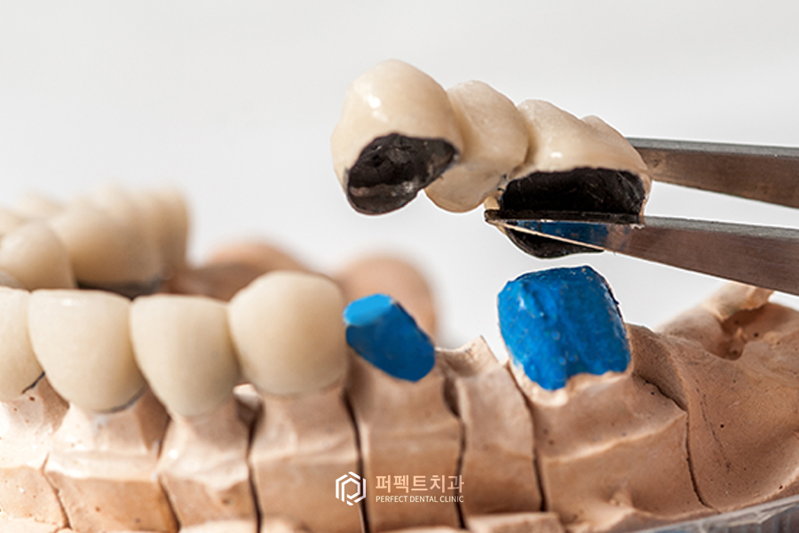 치아가 없을 때 할 수 있는 치료? - ②브릿지/틀니 관련 이미지 1