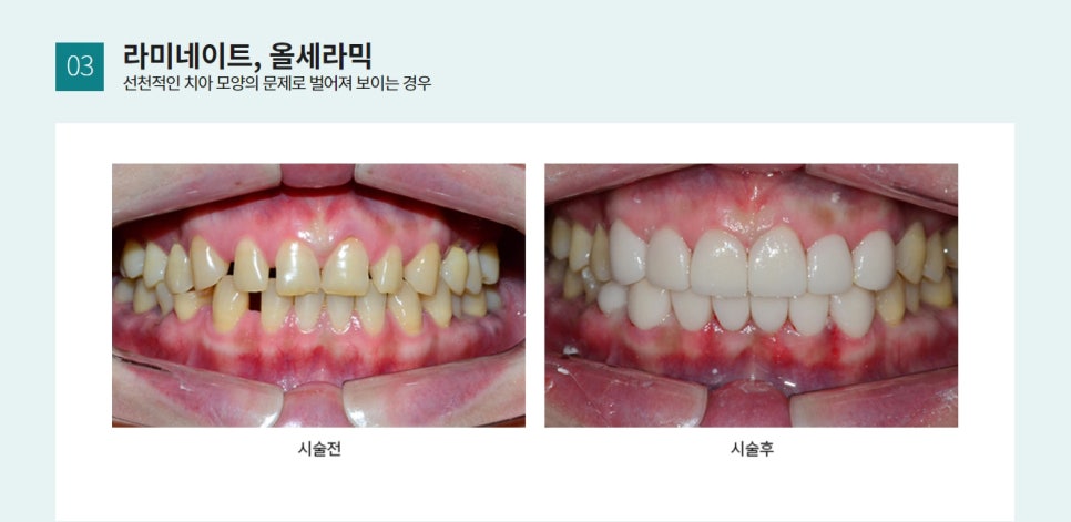벌어진 치아, 무조건 교정을 해야한다? 관련 이미지 5