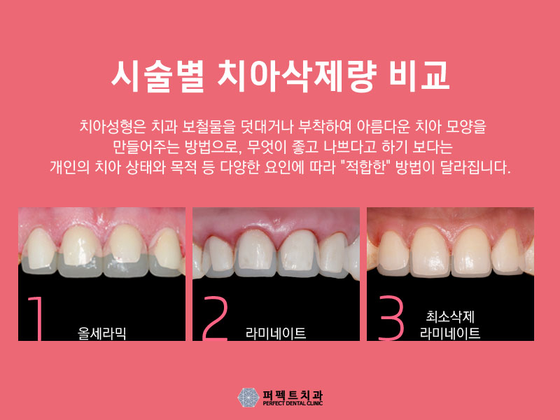 넌 앞니라미네이트 어디서하니? 관련 이미지 1