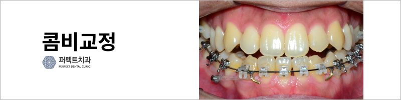 반대교합 비수술 교정 결과는? 관련 이미지 4