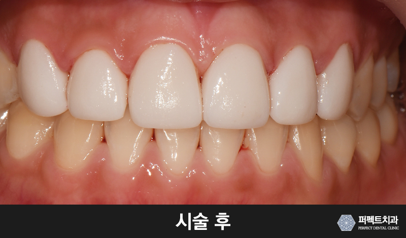 치과, 앞니 라미네이트 가격 관련 이미지 4