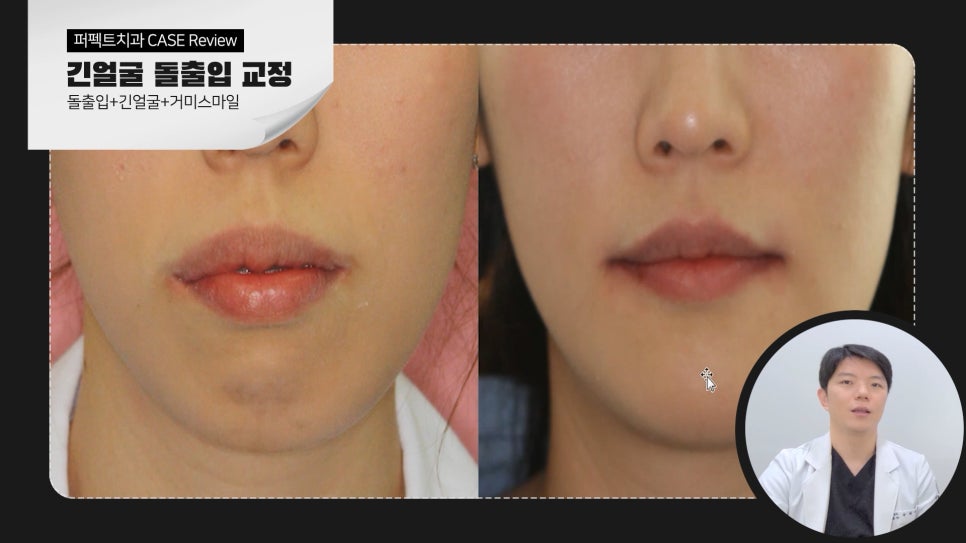긴얼굴+돌출입+거미스마일 비수술교정case 관련 이미지 7