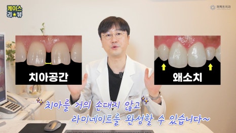 벌어진 앞니 무삭제라미네이트! 관련 이미지 4