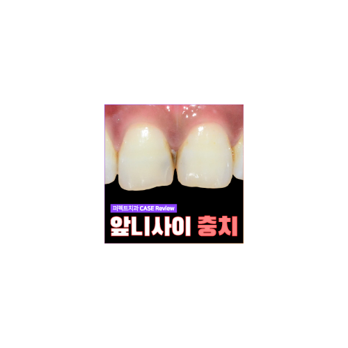 앞니 사이 충치, 최소삭제 라미네이트로! 관련 이미지 5