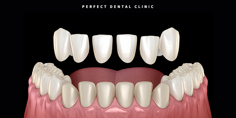 라미네이트, 올세라믹 차이점 관련 이미지 2