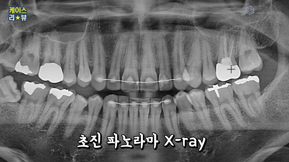 3분만에 임플란트를 할 수 있을까? 가이드임플란트 알아보기 관련 이미지 5