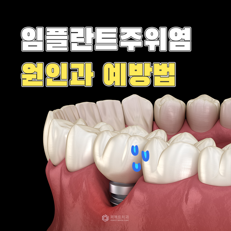 임플란트 상실로 이어질 수 있는 주위염 예방하세요! 관련 이미지 1
