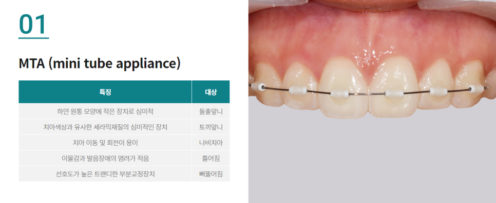 벌어진앞니교정, 원인부터 해결 방법까지 관련 이미지 5