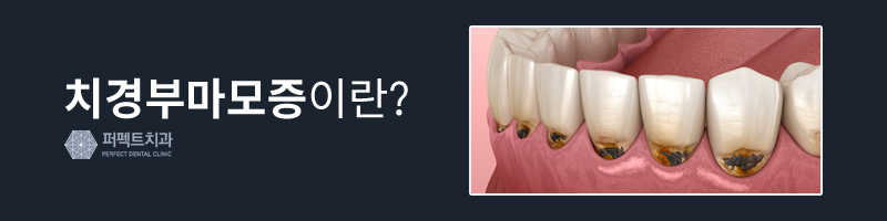 치경부마모증 원인과 치료방법! 관련 이미지 2