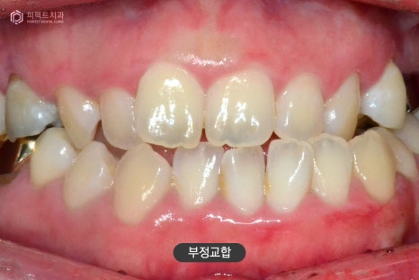 악궁확장장치 MARPE, 사용하는 이유는? 관련 이미지 3