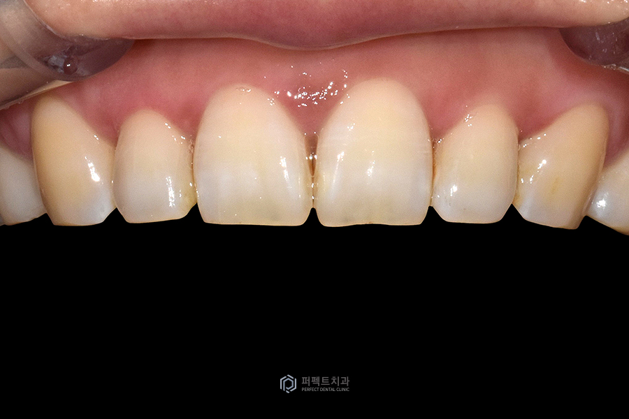 라미네이트 디자인👄｜치과의사가 고른 것vs환자가 고른 것, 어떤 걸로? 관련 이미지 5