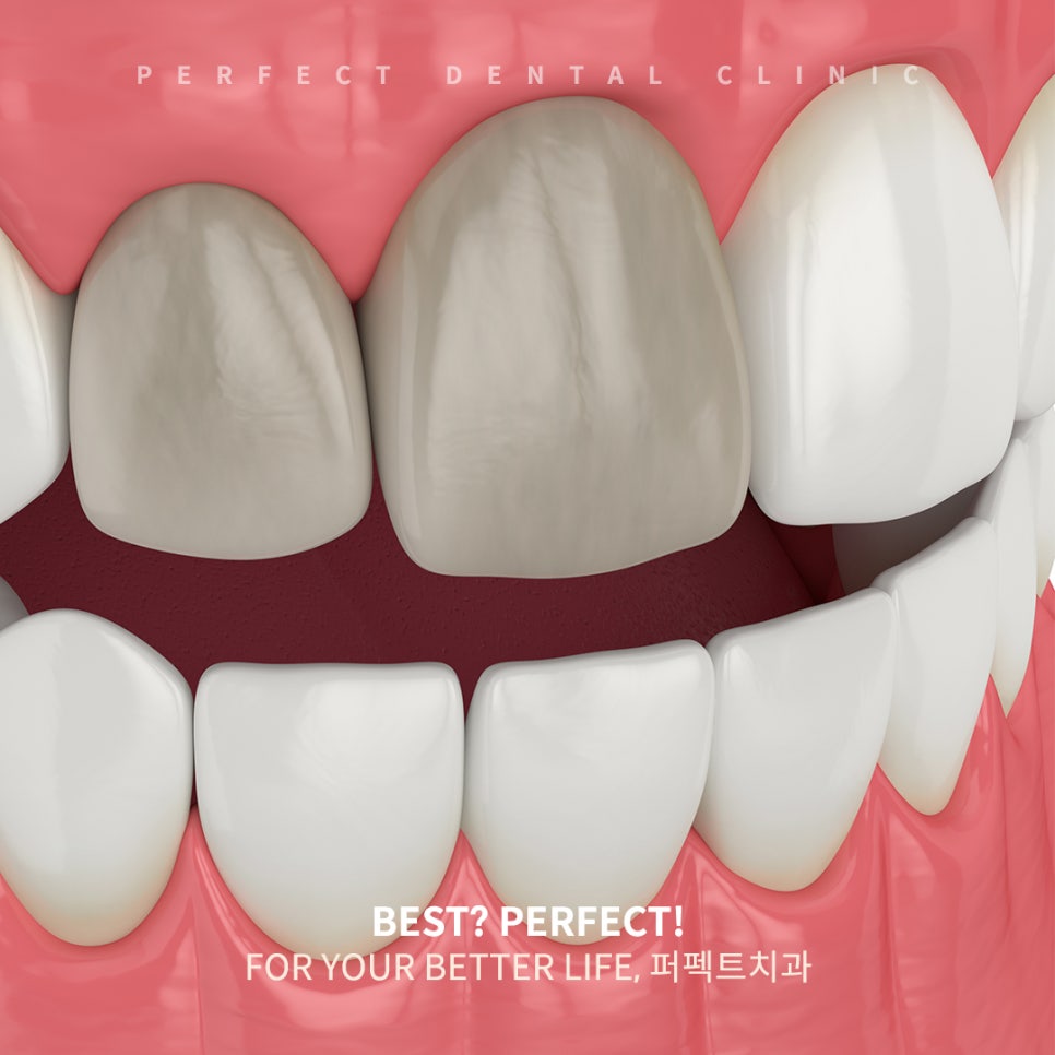 충격으로 누렇게 변한 치아?! 실활치미백으로 하얗게! 관련 이미지 1