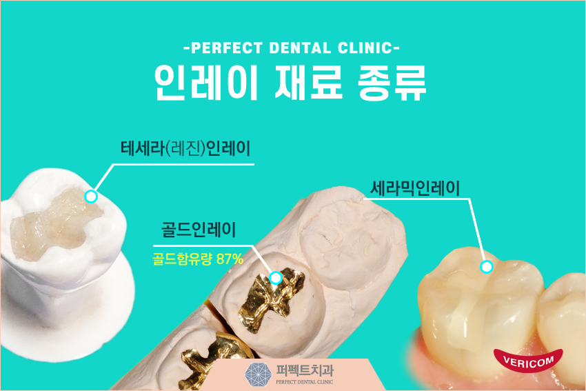 세라믹 인레이 충치치료 비용 관련 이미지 5