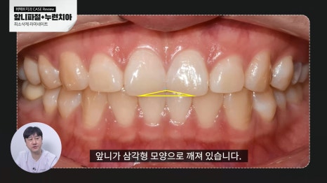 깨진 앞니 치료, 라미네이트로! 관련 이미지 4