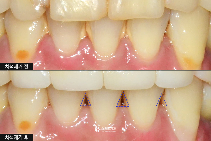 레진으로 변색+마모된 치아, 개선 방법은? 관련 이미지 4