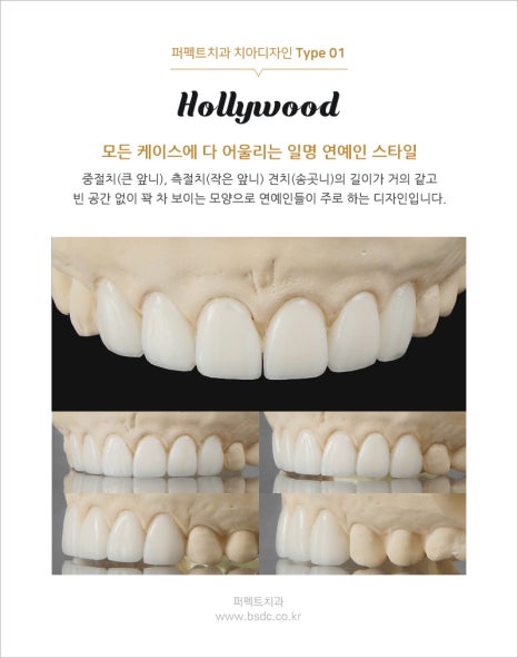 강남역치과, 앞니 라미네이트 가격 관련 이미지 3