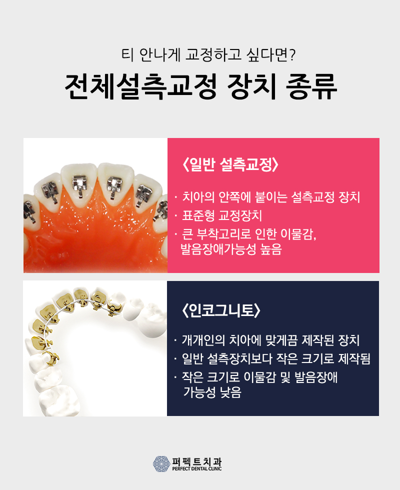 콤비교정&설측교정 비용&hearts; 관련 이미지 3