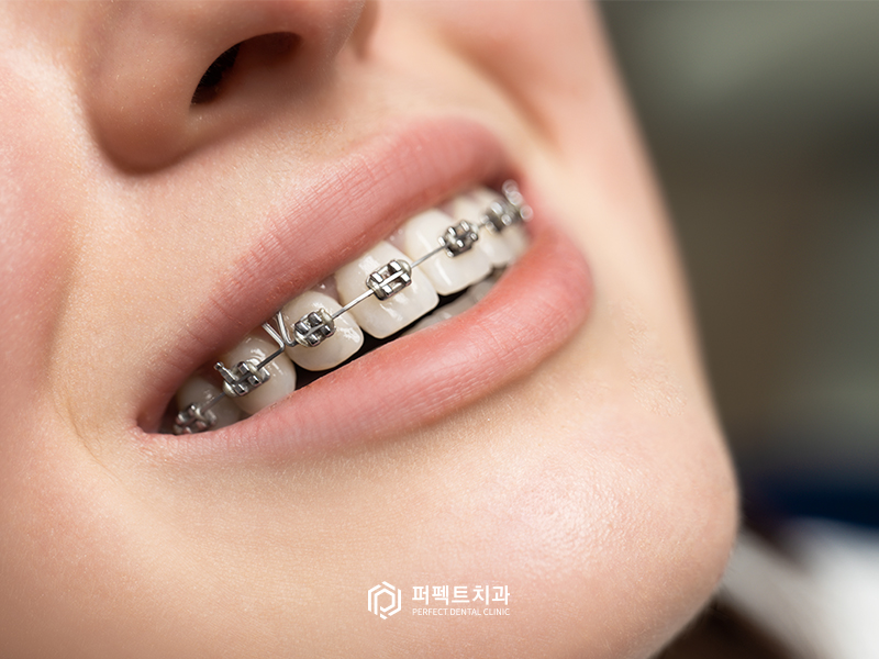 돌출입 교정 시 입을 얼마나 넣을 수 있을까? 관련 이미지 2