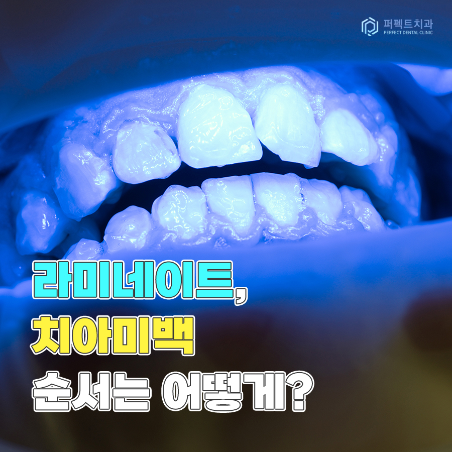 라미네이트와 치아미백 중 어떤 것을 먼저 해야할까요? 관련 이미지 1