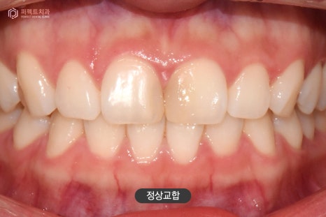 악궁확장장치 MARPE, 사용하는 이유는? 관련 이미지 2