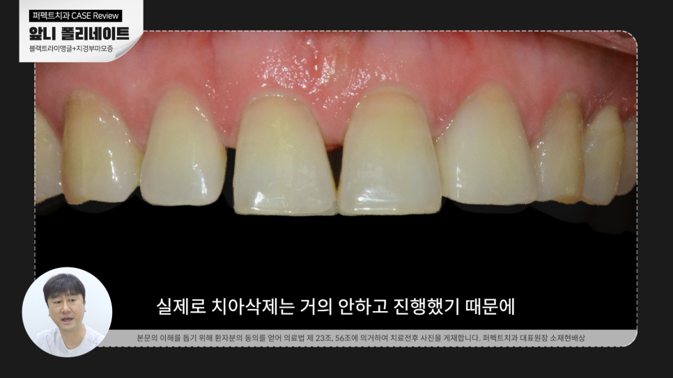 앞니 사이 틈, 블랙트라이앵글 치료방법 어렵지 않아요. 관련 이미지 4