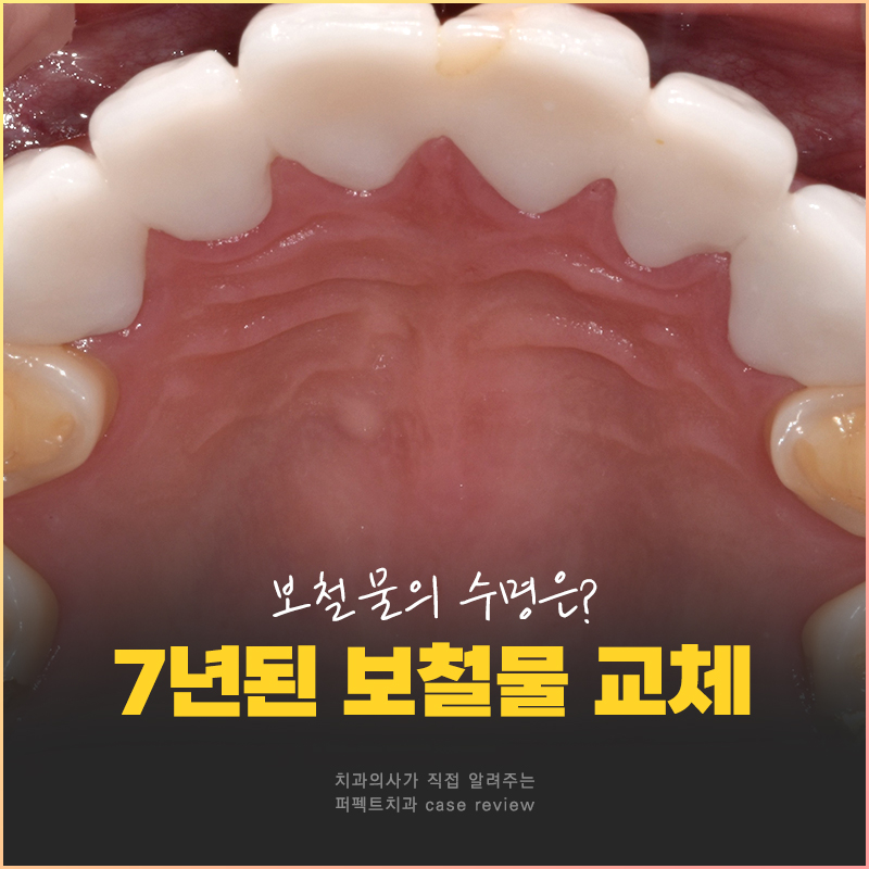 보철치료, 10년 후에는 교체를 해야한다?🤨 관련 이미지 1